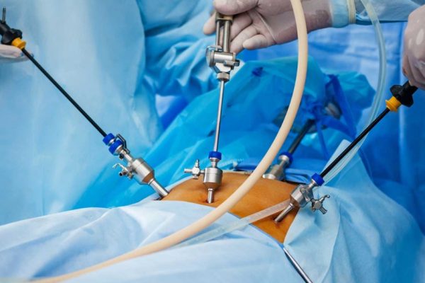 38213-problema-intervento-chirurgia-laparoscopica